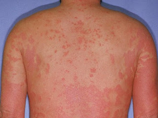 Como cauterizar la psoriasis